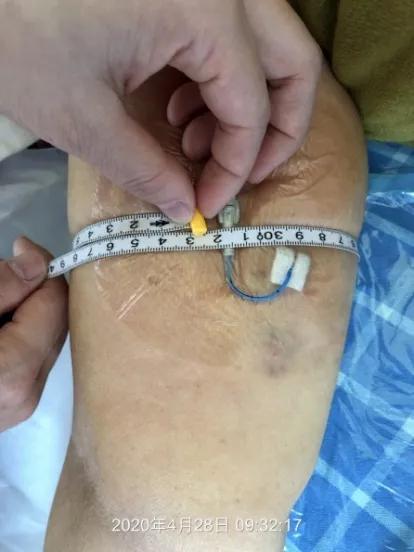 留置picc需要什么医嘱,picc静脉置管能随时拔除