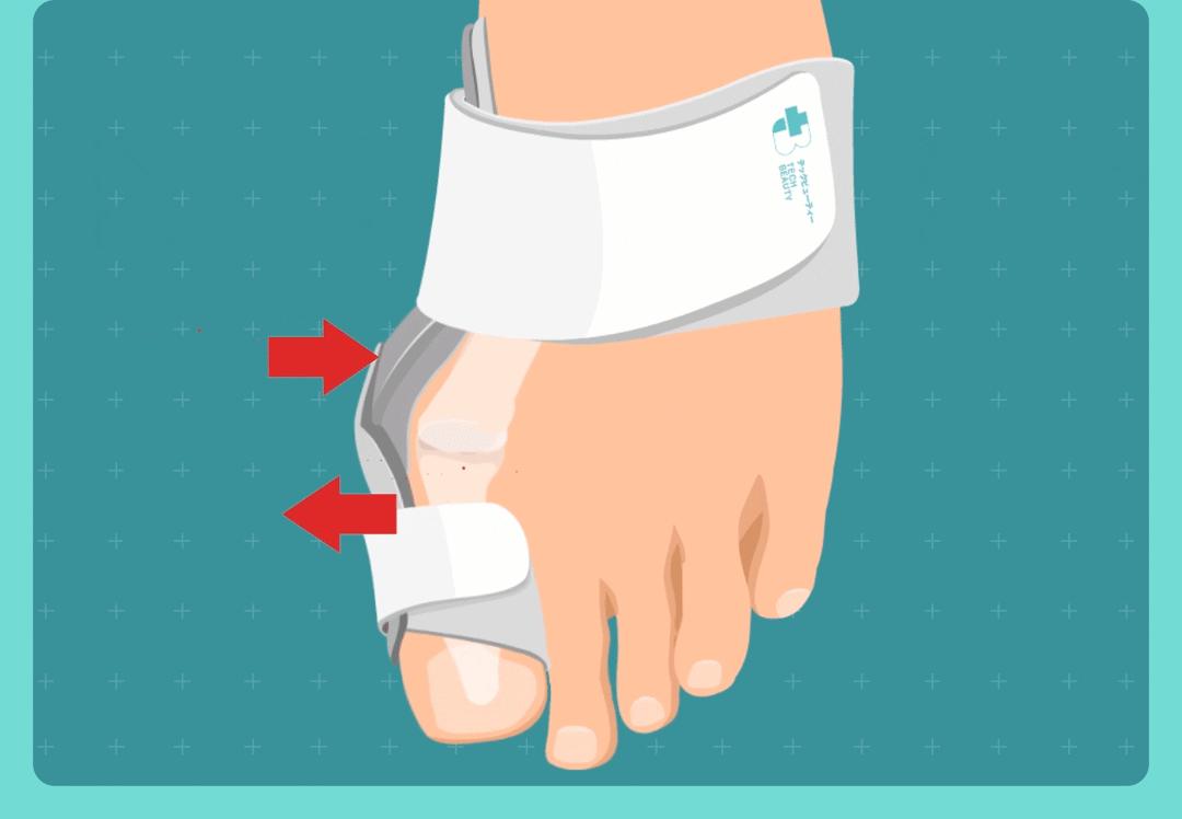 大脚趾拇指外翻矫正用多久,大脚拇指外翻导致第二脚趾弯曲