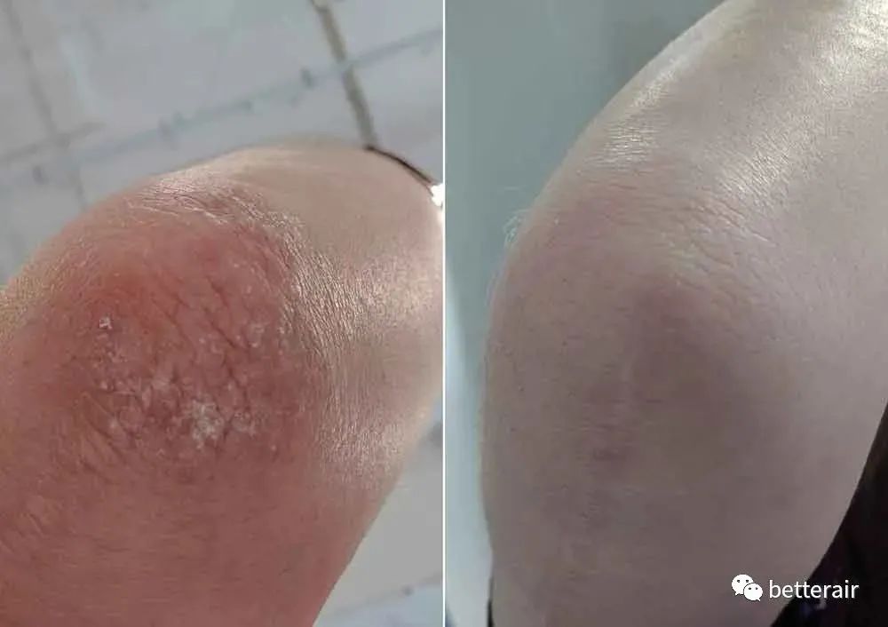 宝宝湿疹发作,痒痛到又哭又叫,直到betterair出现