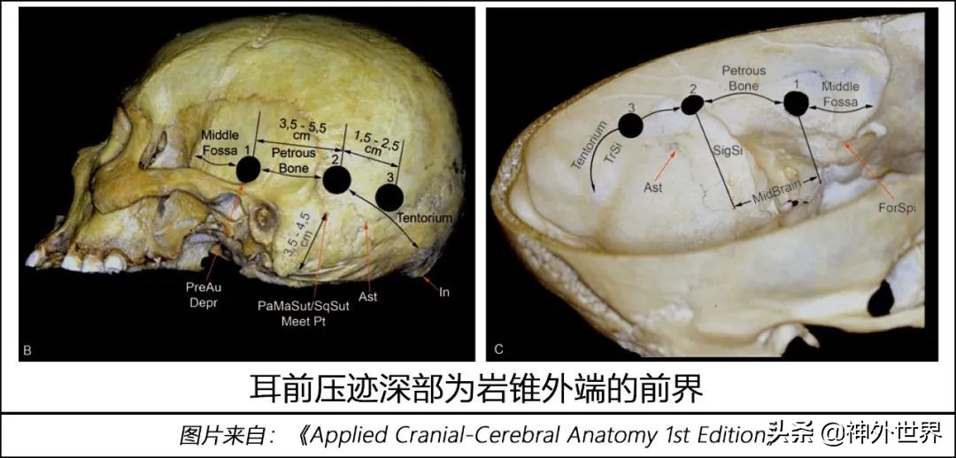 颞骨解剖,颞肌解剖讲解