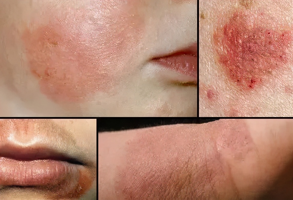 得湿疹了自己会好吗,得了湿疹要忌什么