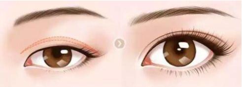 什么原因导致双眼皮不明显,双眼皮增生了会自己消失吗
