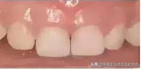 乳牙预成冠的功效与作用,儿童乳牙预成冠一颗多少钱