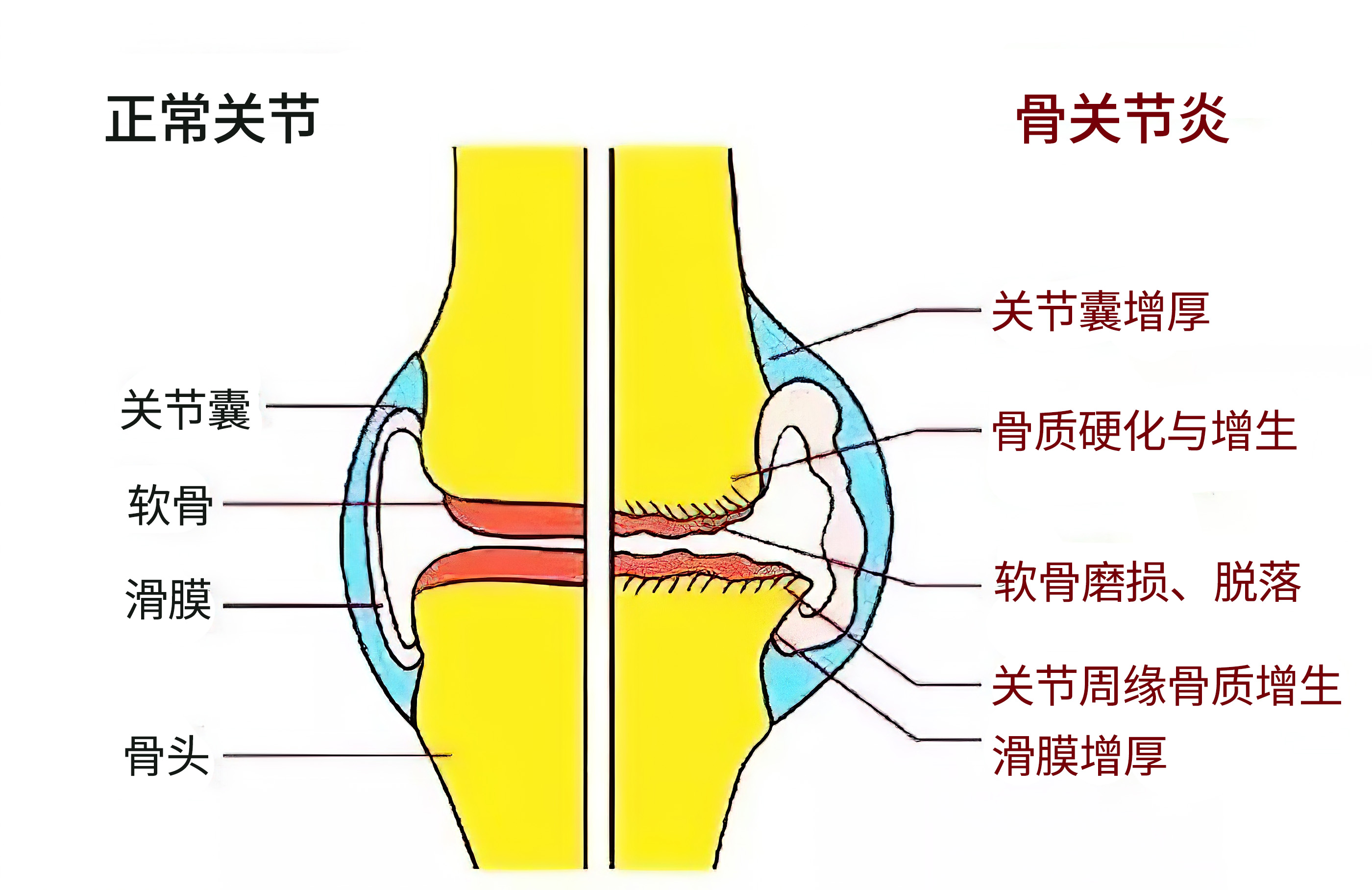 膝关节痛吃布洛芬缓释胶囊有用吗,得了膝关节退变要不要吃药