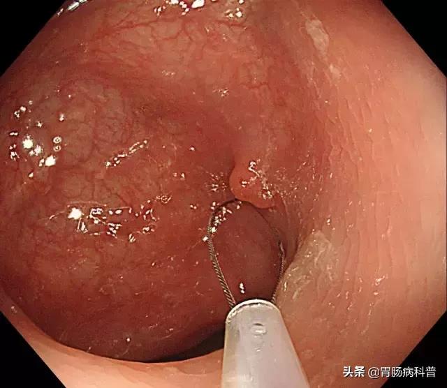 长了胃息肉怎么治疗好,长了胃息肉会有什么症状
