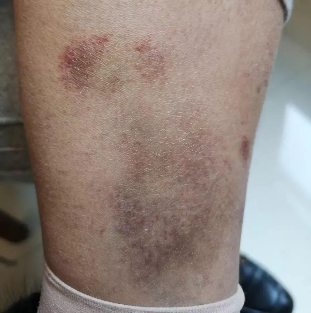 色素性紫癜性皮肤病是啥,色素性紫癜性皮肤病是什么
