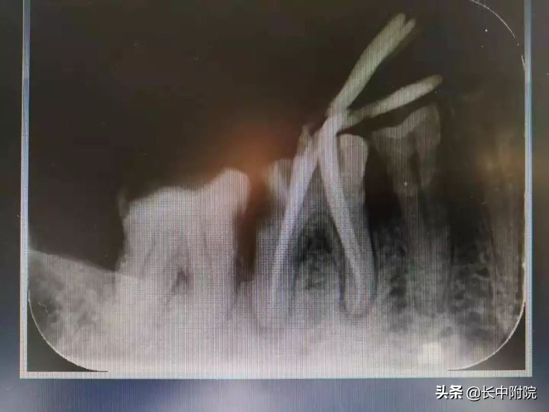 口腔根管治疗技术,口腔根管治疗怎么学好