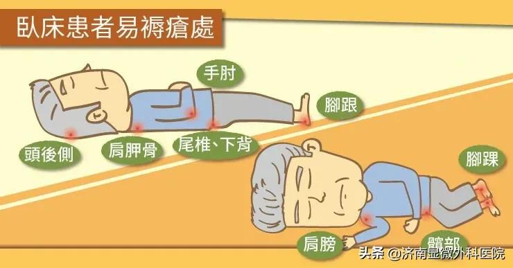 得了褥疮初期怎样治能快速好,褥疮和压疮用什么治疗