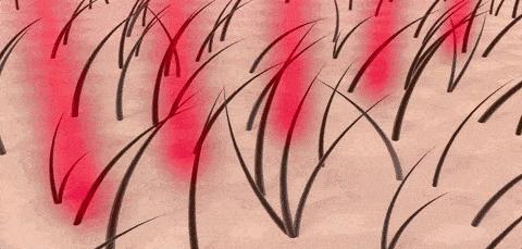 前胸后背长痘痘是毛囊炎吗,前胸后背很容易长痘痘中医治疗