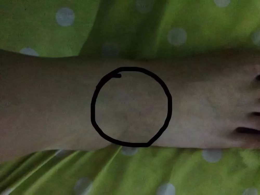 针灸针刺异常处理,针灸中出现的异常情况