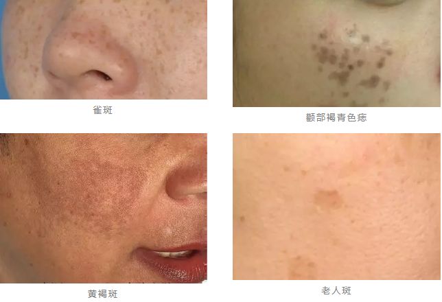 皮秒祛斑效果怎么样值得做吗,皮秒祛斑祛痣怎么样