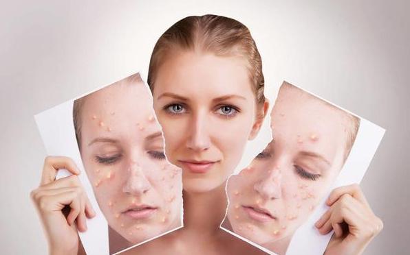 吃糖长痘还是吃脂肪长痘,吃糖脸上长痘跟糖尿病有关系吗