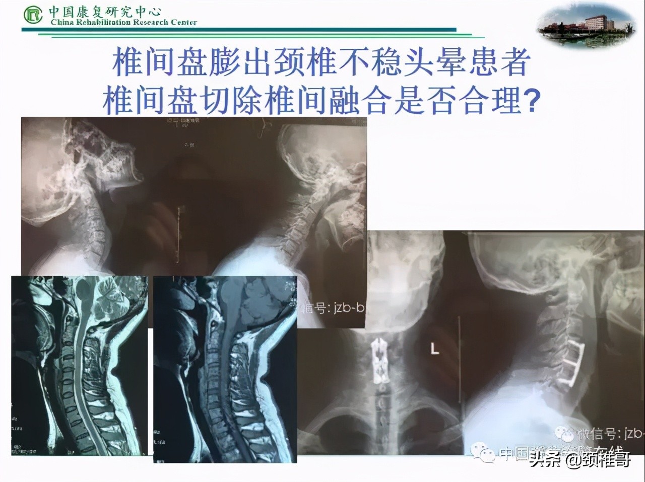 颈椎病的护理临床路径流程图,颈椎病的健康管理与康复指导