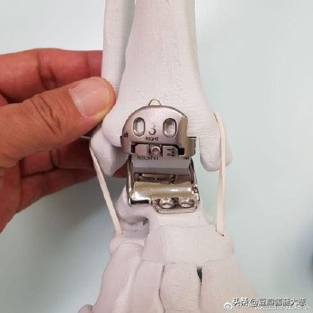 射手巴蒂斯图塔,巴蒂斯图塔换脚踝