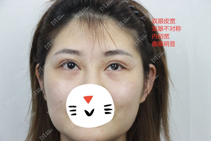 双眼皮线条凹陷疤痕怎么修复,双眼皮手术后如何避免疤痕和增生