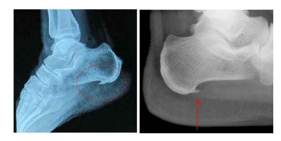 长骨刺说明你身体开始变老了,长骨刺的原因和治疗方法