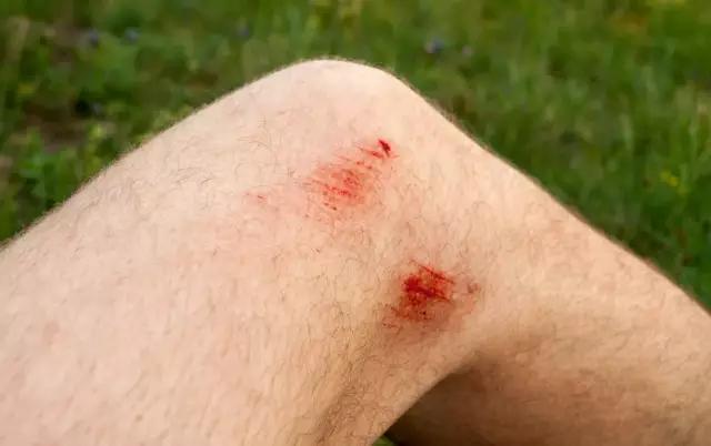 运动擦伤预防及处理的视频,运动擦伤正确处理方法动画