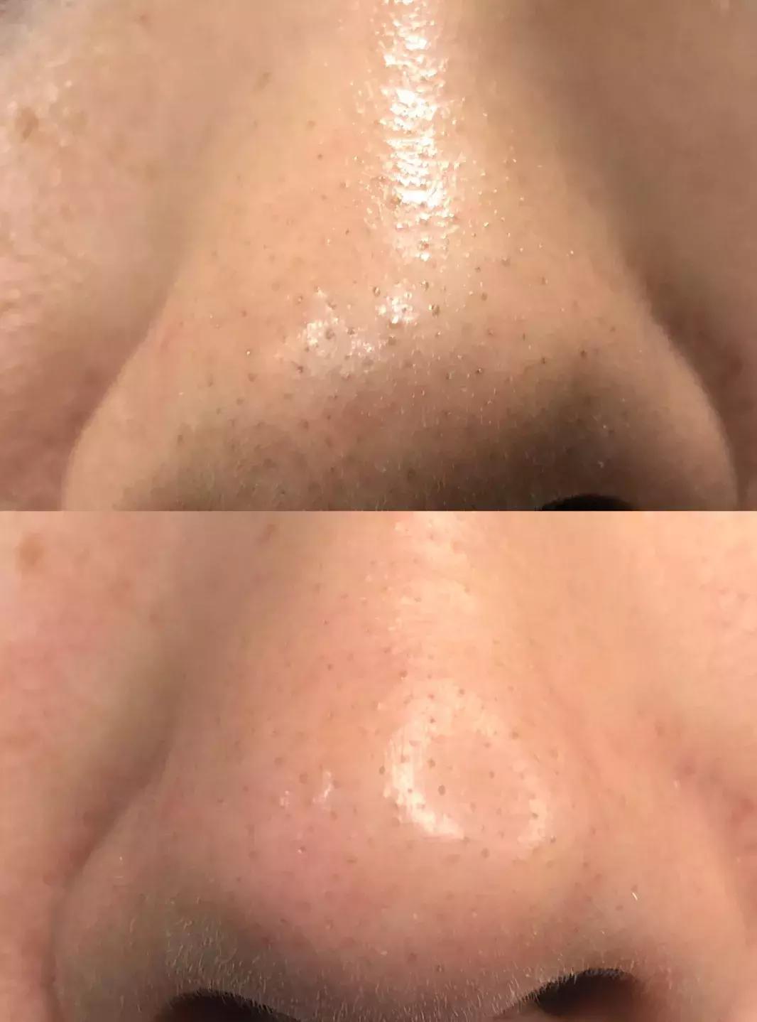 吸黑头神器去粉刺角质收缩毛孔,皮肤清洁收缩毛孔黑头角质