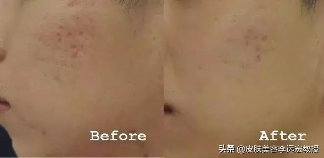 婴儿针是微针还是水光,bb针和水光针的区别