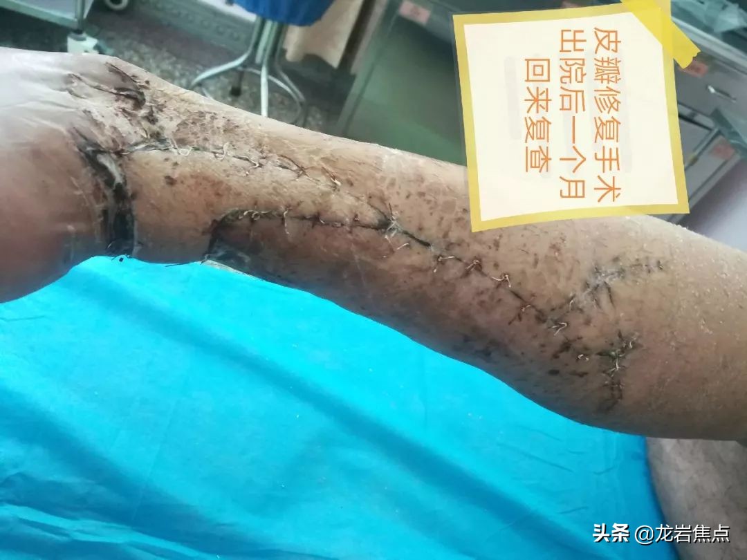 整块皮没了怎么处理,整块皮肤没了会增生吗