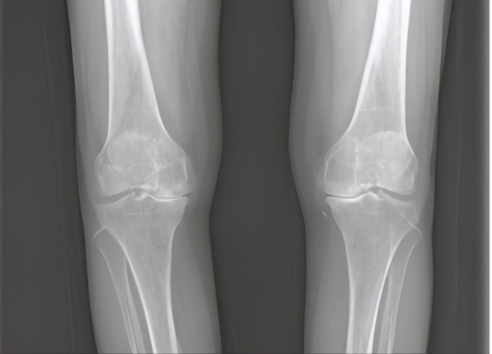 不同膝盖疼痛是暗示什么,不同位置的膝盖疼