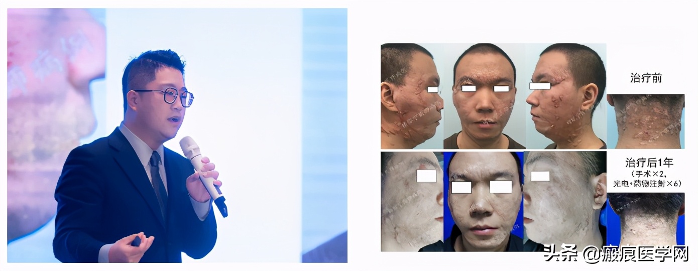 鐦㈢棔妗堜緥,鐤ょ棔娌荤枟鎴愬姛妗堜緥