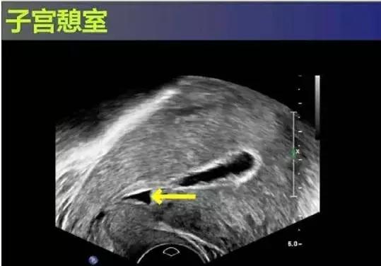 子宫憩室后遗症有哪些,子宫憩室手术治疗有哪些危害