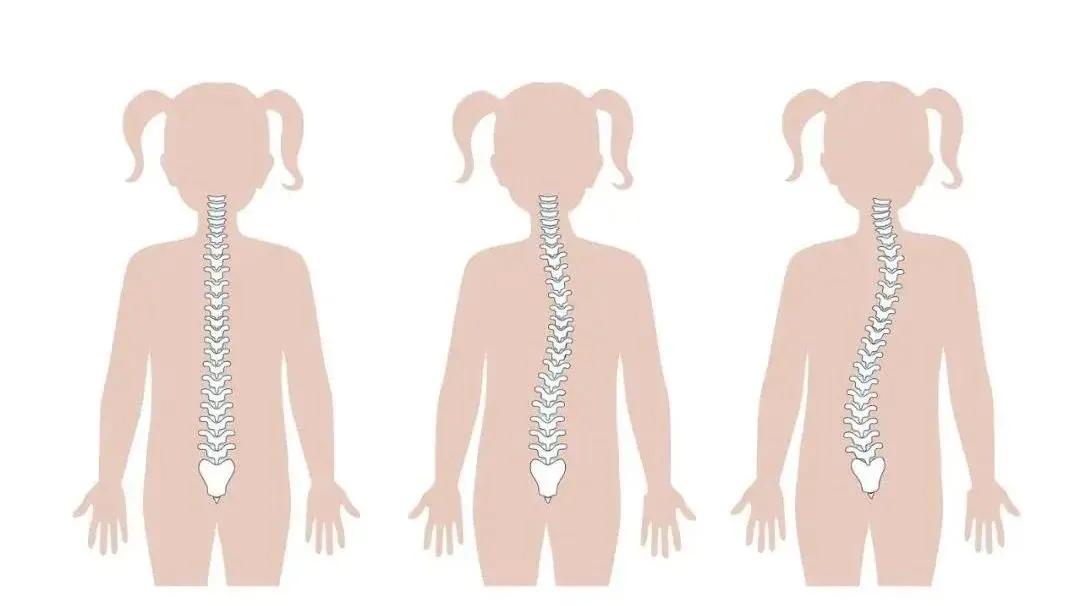 治疗青少年脊柱侧弯最好的方法,四种危害青少年成长的健康杀手