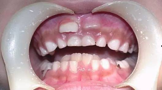 小孩乳牙蛀了做根管有必要吗,小孩子乳牙被蛀空了需要去处理么