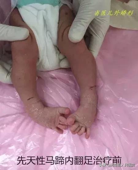 宝宝脚尖站立的原因,宝宝脚尖对脚尖走路怎么回事