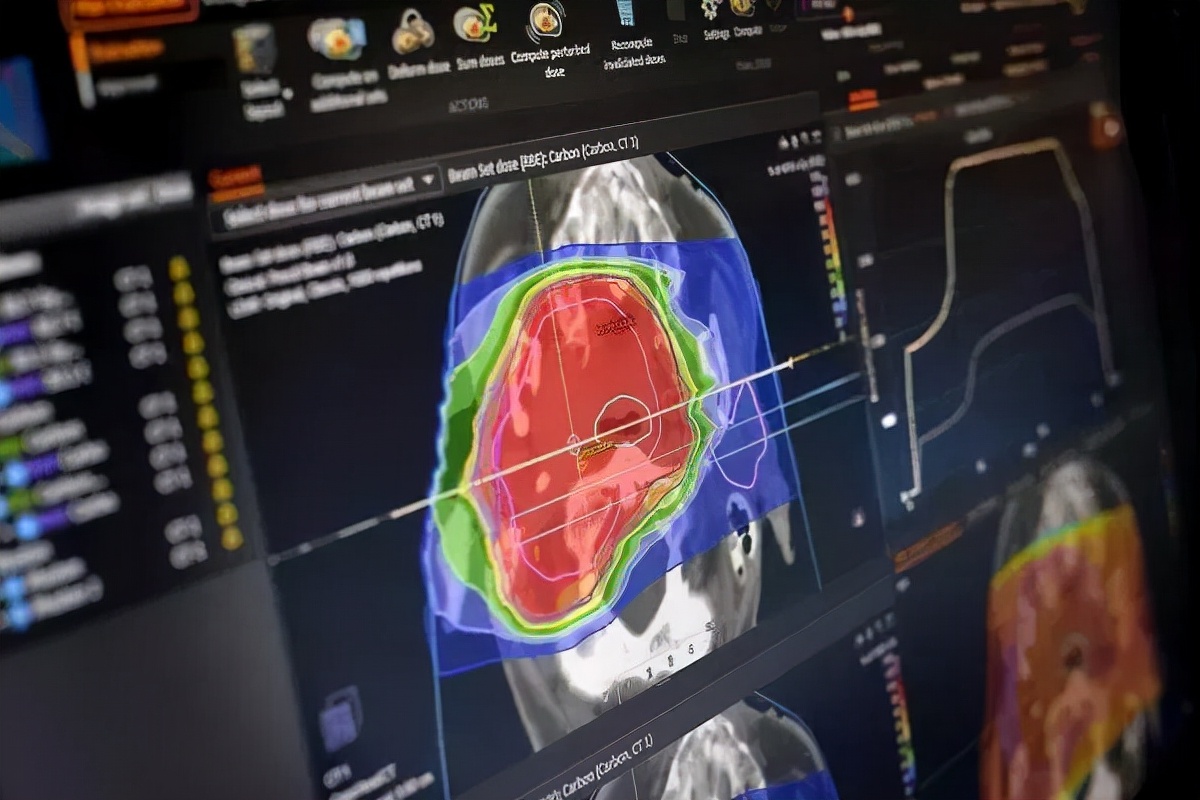 质子重离子治疗真实效果图,重离子治疗全过程