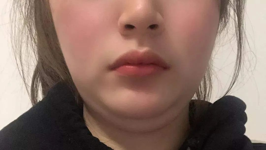 石原里美同款“钻石下颌线”，7天到位