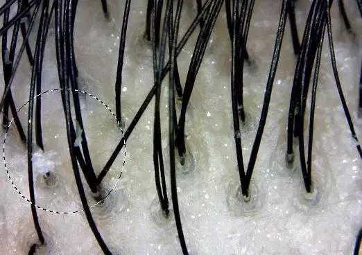 头发毛躁并且脱发推荐洗发水,用什么洗发水改善头皮脱发