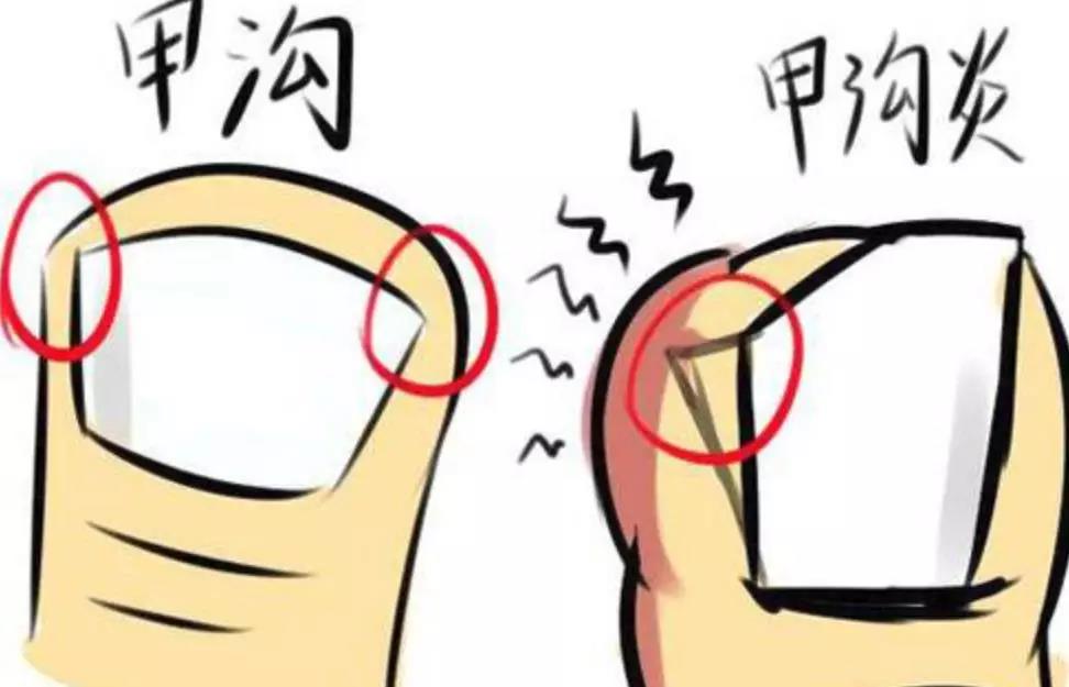 勤修脚能治好甲沟炎吗,勤剪指甲卫生常识