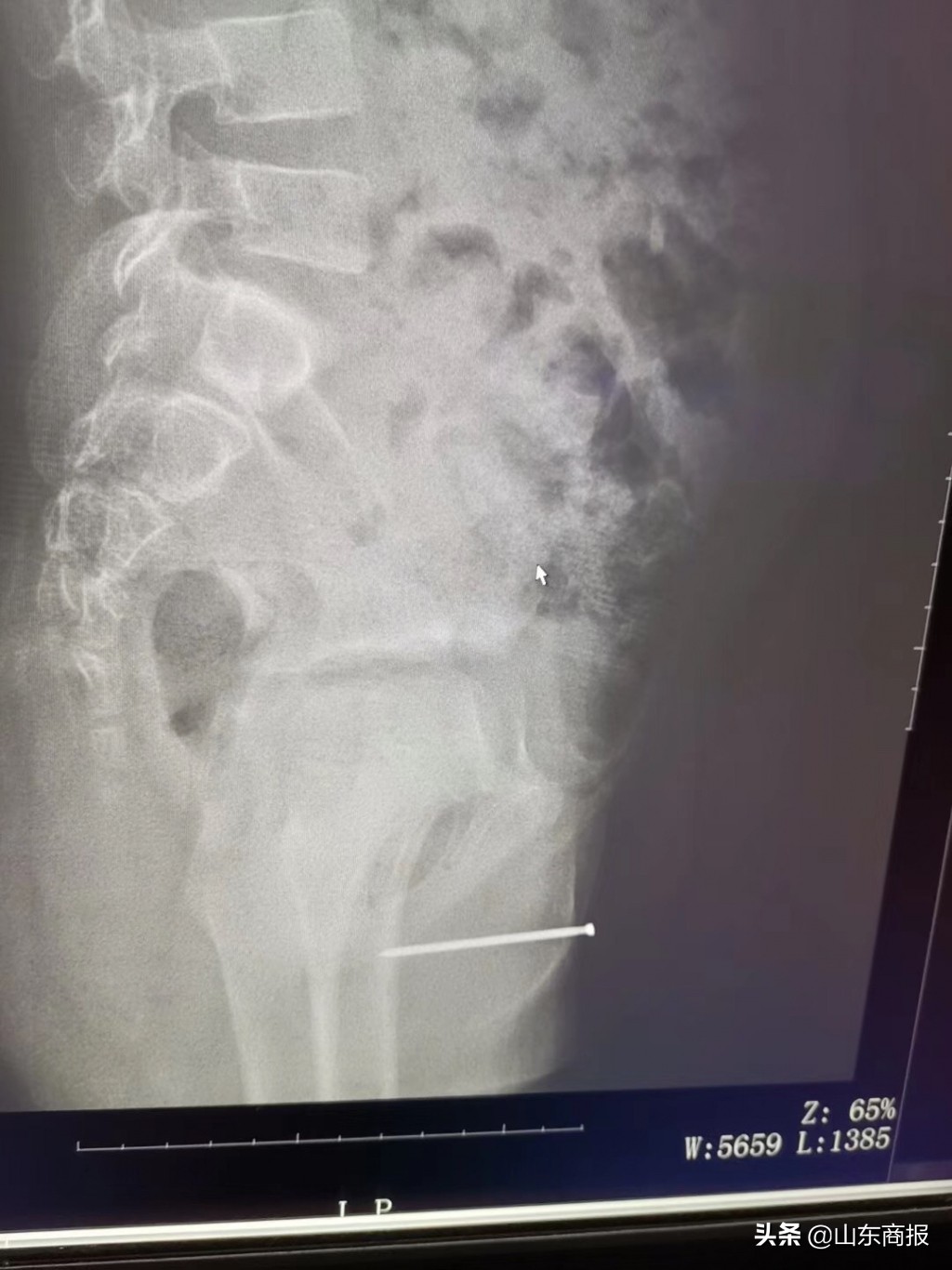 7岁男童尿道内塞入异物,手术取出4.7厘米长铁钉