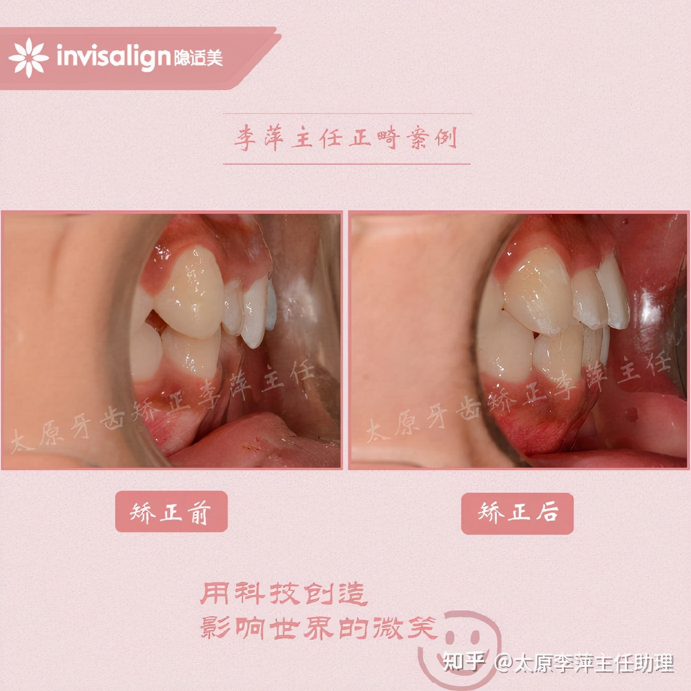 太原牙齿矫正靠谱吗,太原成人隐形牙套牙齿不齐