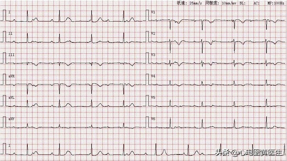 三度房室传导阻滞，房室干扰性脱节，怎么看？