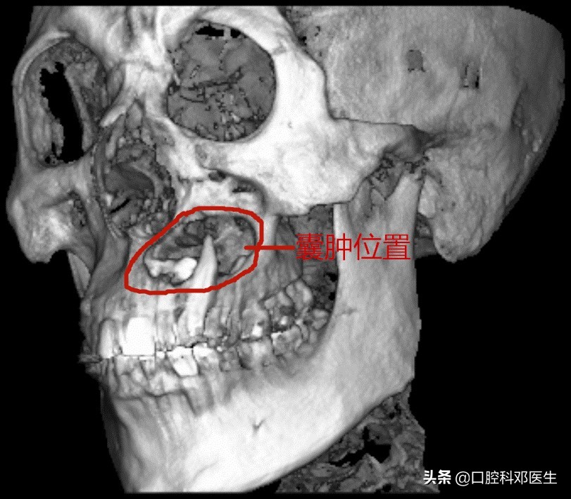 上颌埋伏阻生牙拔除多久能矫正,水平阻生埋伏牙真实拔除过程