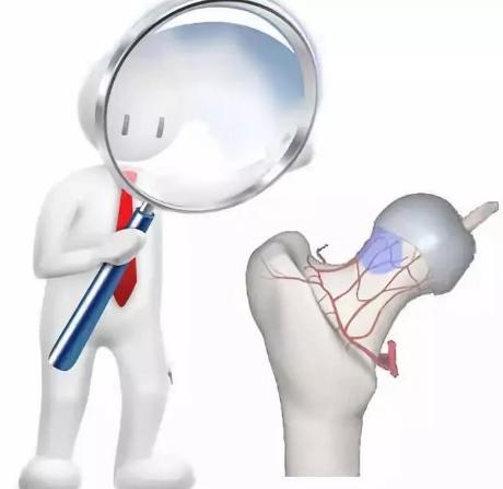 什么是股骨头坏死原因,股骨头坏死和股骨头缺血性坏死