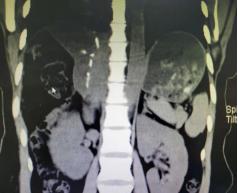 20cm肝血管瘤手术失败,8公分肝血管瘤切除肝脏