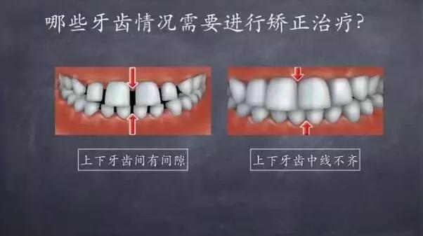 牙齿矫正拔牙后会反弹成原样么,牙齿矫正后反弹可以重新矫正吗