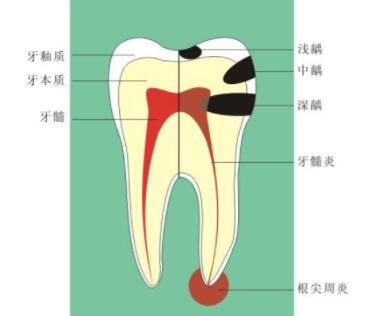牙齿反复发炎,吃药也没用!该怎么治疗才好?