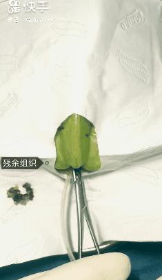 我在快手上看人切洋葱，竟然弄懂了剖腹产？