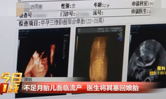 胎儿刚24周母亲要求剖腹产,胎儿只有24周孕妈妈坚决要剖腹产