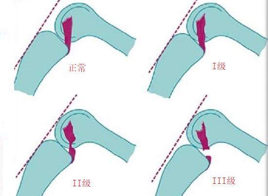 后交叉韧带损伤分什么情况,膝关节前交叉韧带损伤