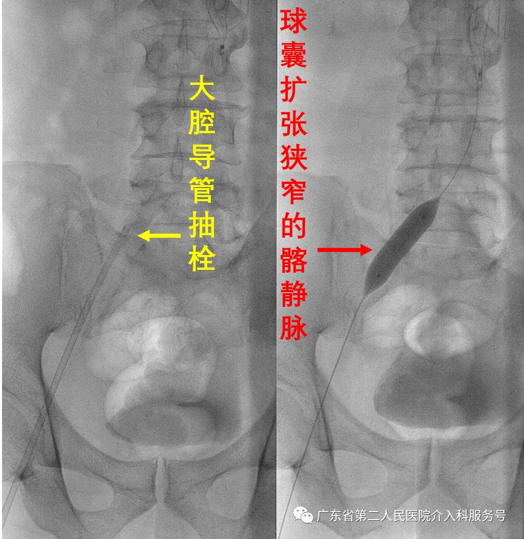 左腿血栓的最快消除方法,左腿浮肿有血栓用什么药治疗