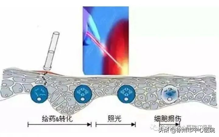 光动力治疗hpv多久后复查,光动力治疗后需要多久复查
