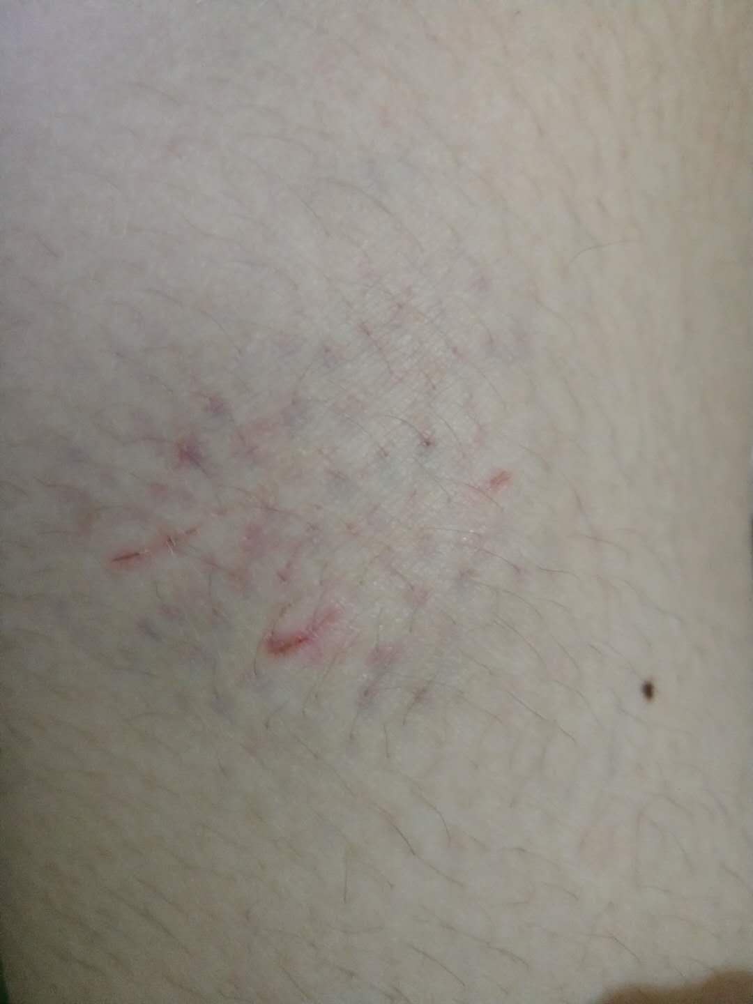 被猴子咬了需要打疫苗吗,被猴子咬要打狂犬疫苗吗