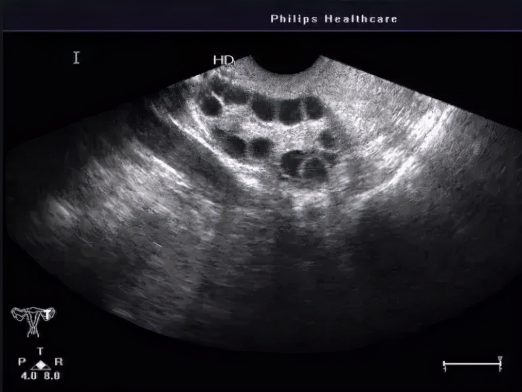 体检卵巢有个囊肿要紧不要紧,体检卵巢囊肿什么原因
