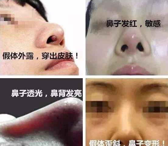 余文林鼻子矫正,余文林唇裂整形修复术